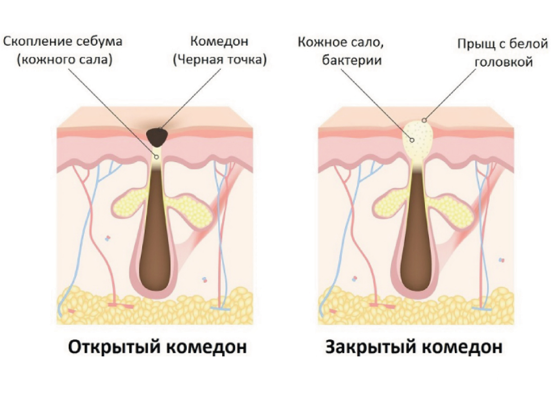 Закрытые комедоны на лбу